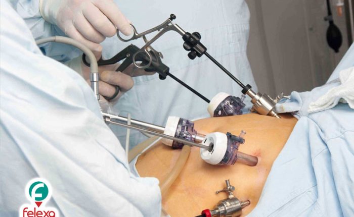 جراحة تقليل الوزن في ايران