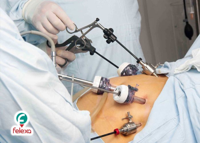 جراحة تقليل الوزن في ايران