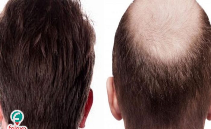 زراعة الشعر في إيران