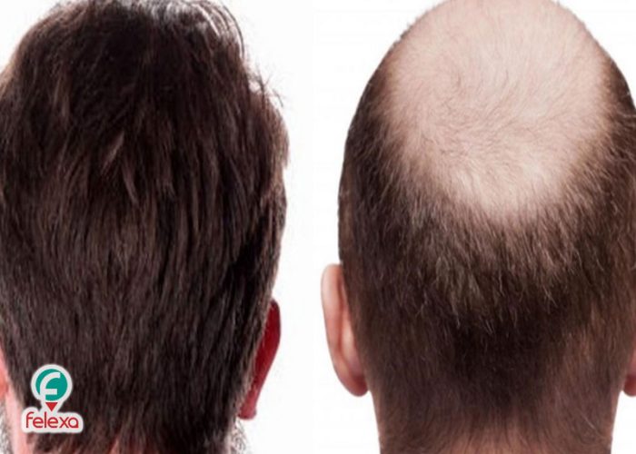 زراعة الشعر في إيران